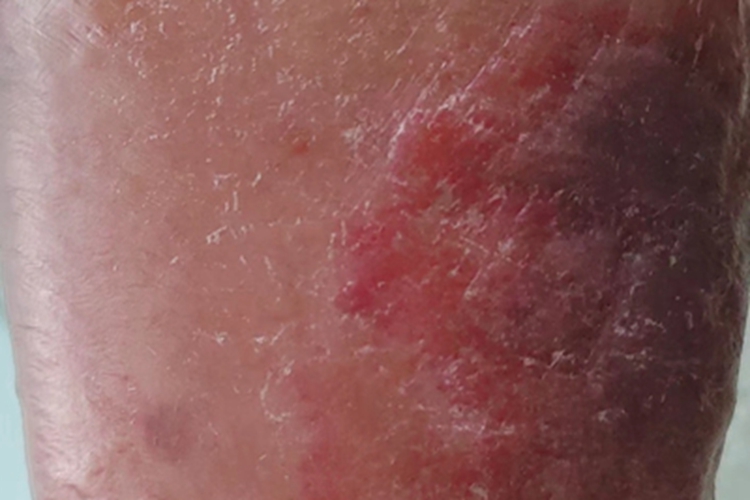 丹毒水疱图 丹毒水疱图