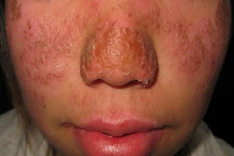 寒冷性多形红斑面部长红斑结痂图