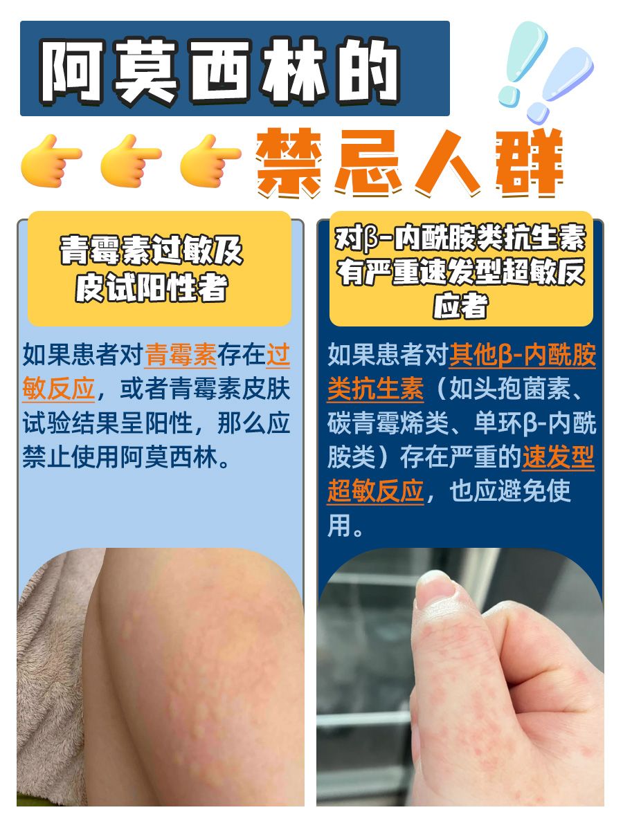 解锁阿莫西林正确吃法，一次几粒有讲究