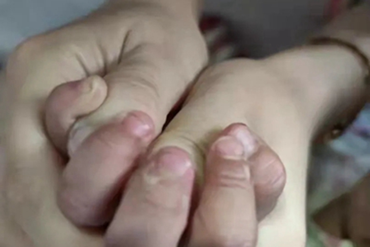 川崎病手指尖掉皮图