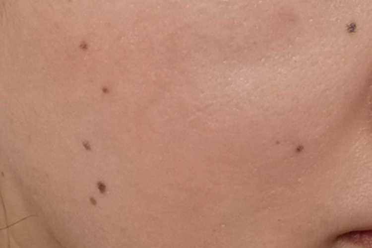 交界痣脸上有多个黑斑图