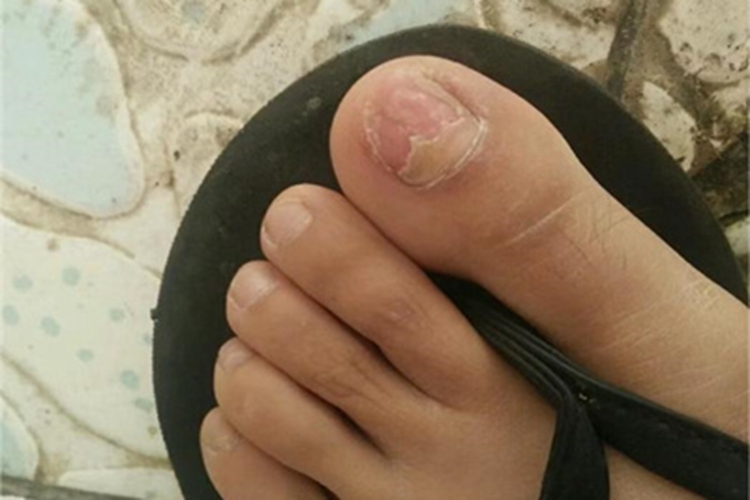 慢性甲沟炎脚趾甲缺了一半图