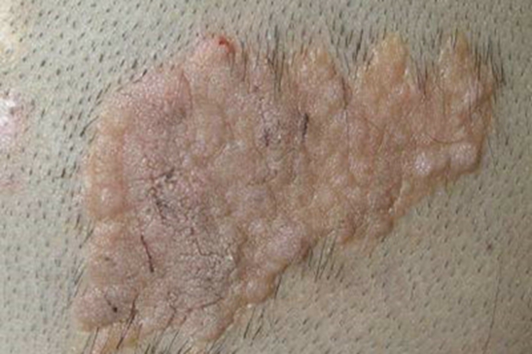 皮脂腺痣头皮斑图