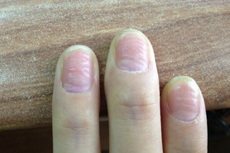 甲分离指甲表面凹凸不平图 甲分离指甲表面凹凸不平图