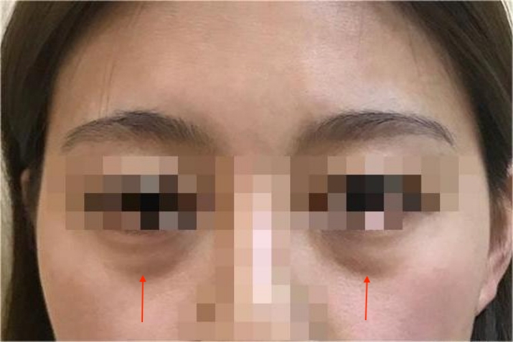 结构性黑眼圈图