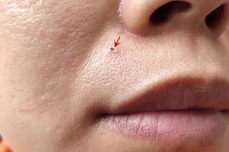 交界痣面部小坑图 交界痣面部小坑图