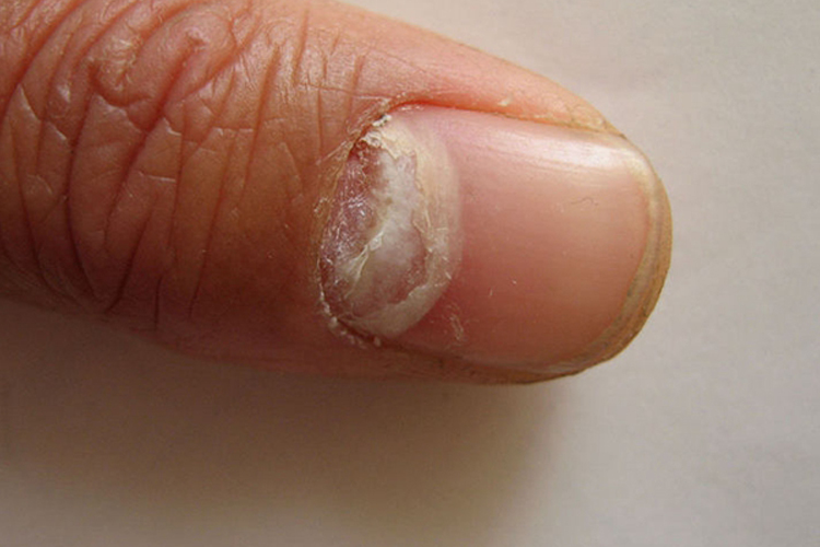 近端甲下型甲真菌病图