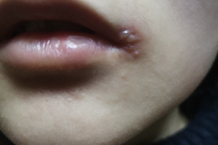 感染性口角炎嘴角长水疱图 感染性口角炎嘴角长水疱图