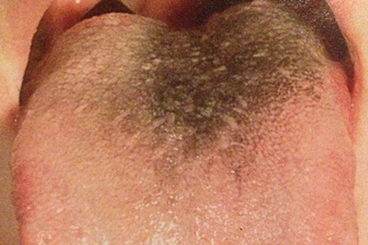 毛舌舌头上有黑色斑块图