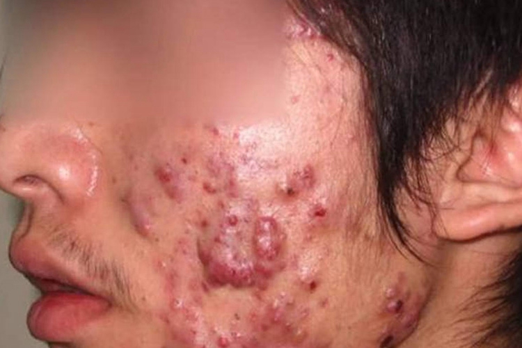 青春期男孩脸上长痘痘图