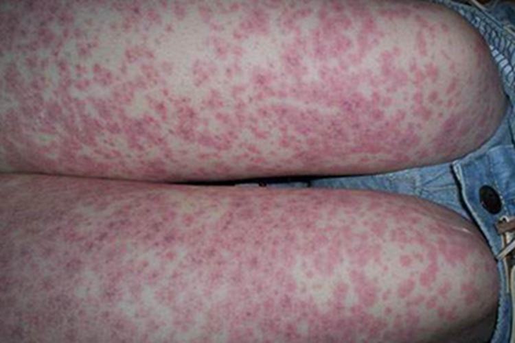 过敏性紫癜疙瘩图 过敏性紫癜疙瘩图