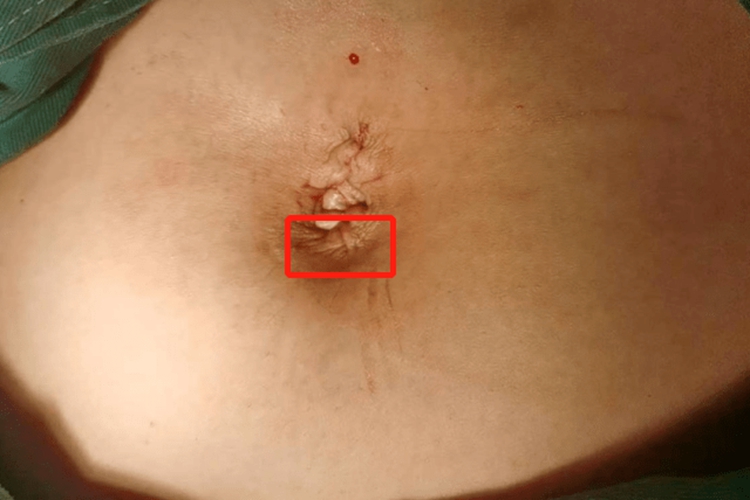 黄体手术疤痕图