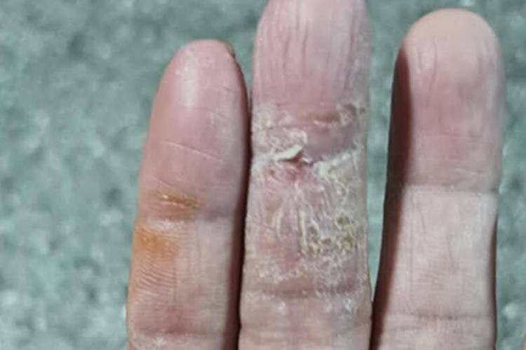 手部湿疹手指干燥脱皮图