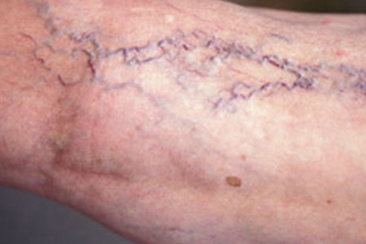 游走性血栓性静脉炎腿部症状图