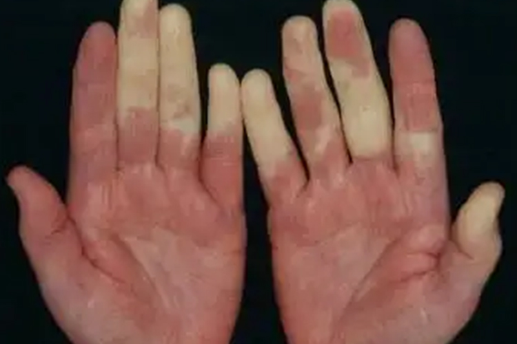 雷诺综合征早期图