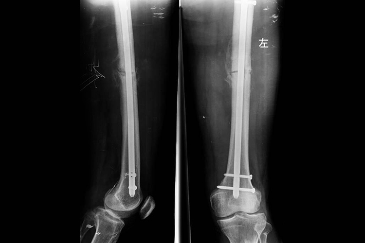 大腿骨干骨折髓内钉固定X线图