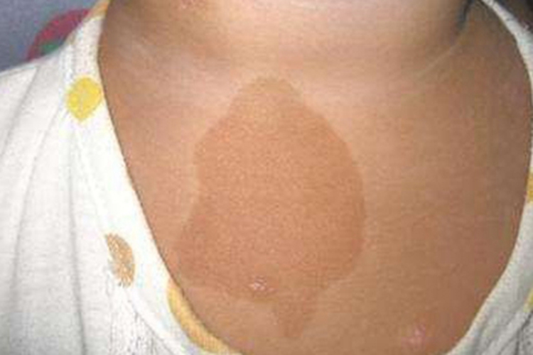 奥尔布赖特综合征胸部斑图