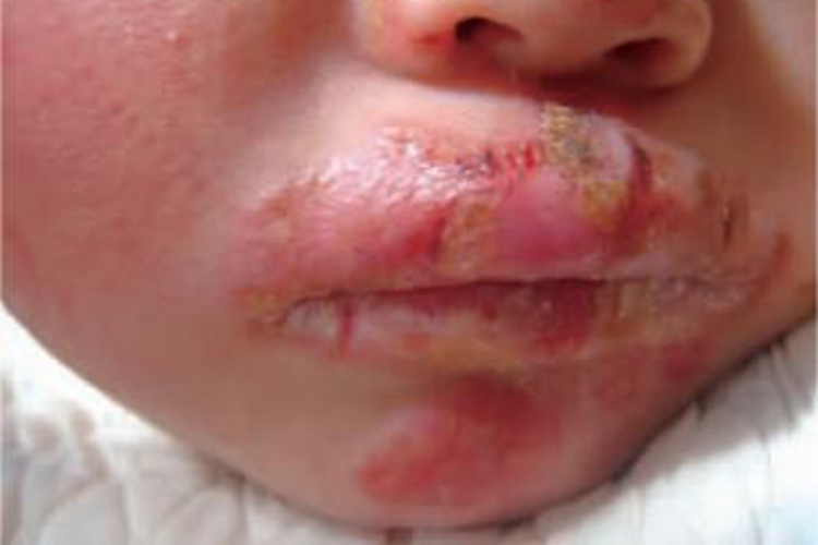 慢性黏膜皮肤念珠菌病嘴唇红斑图 慢性黏膜皮肤念珠菌病嘴唇红斑图