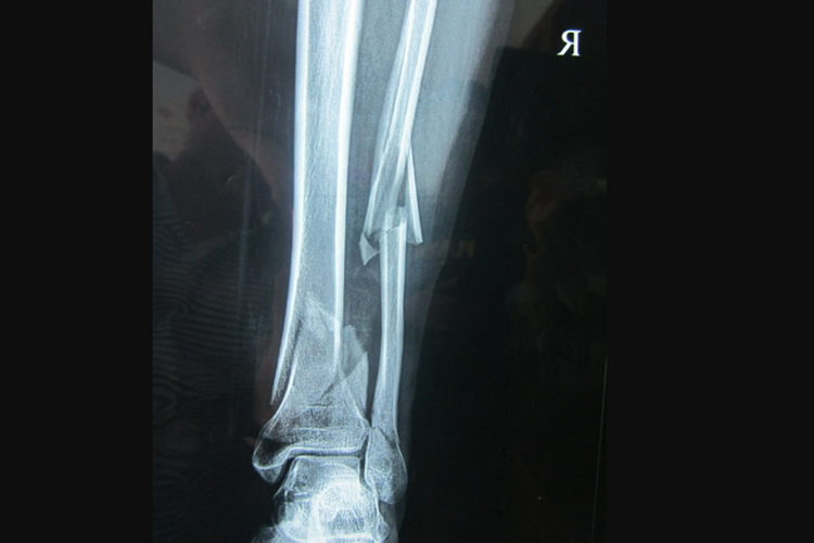 小腿腓骨骨折X线图