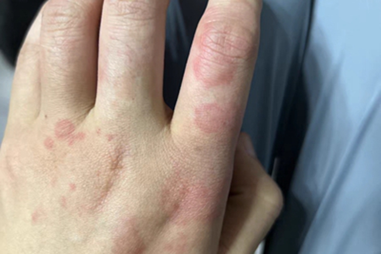 急性自发性荨麻疹手背红斑图 急性自发性荨麻疹手背红斑图