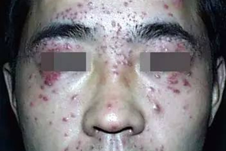 中间界线类麻风面部有红色疙瘩图