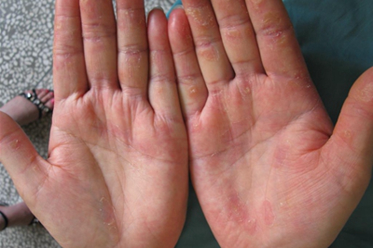 女性三期梅毒手掌脱皮图