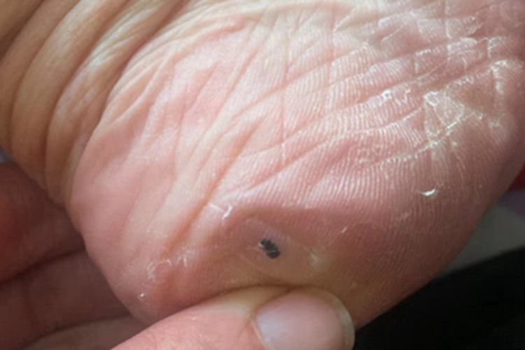 交界痣脚后跟黑痣图