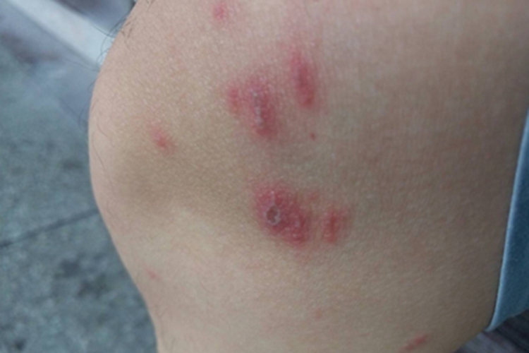 皮肤非典型分枝杆菌病膝盖红斑图