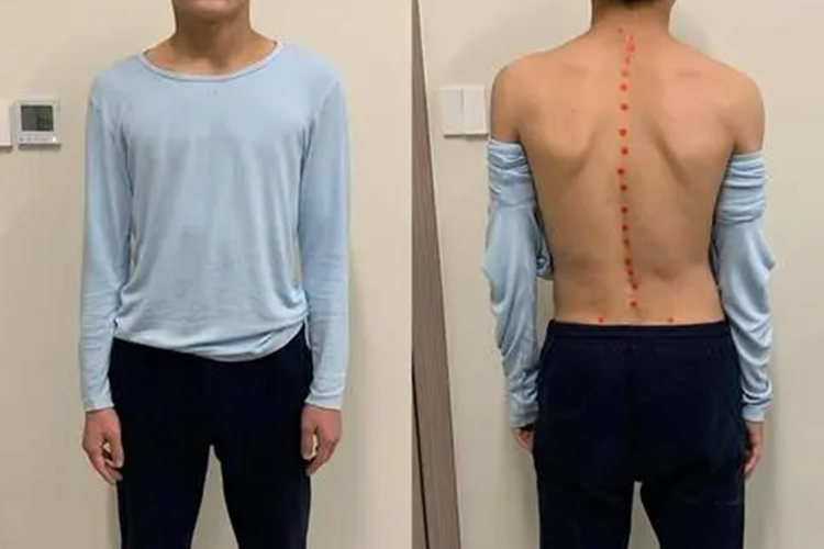 胸椎侧弯15度图