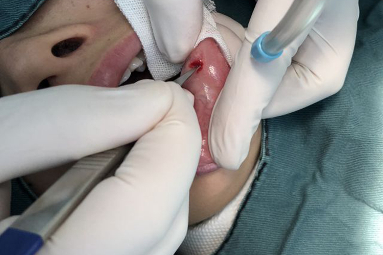 黏液腺囊肿切开黏膜图