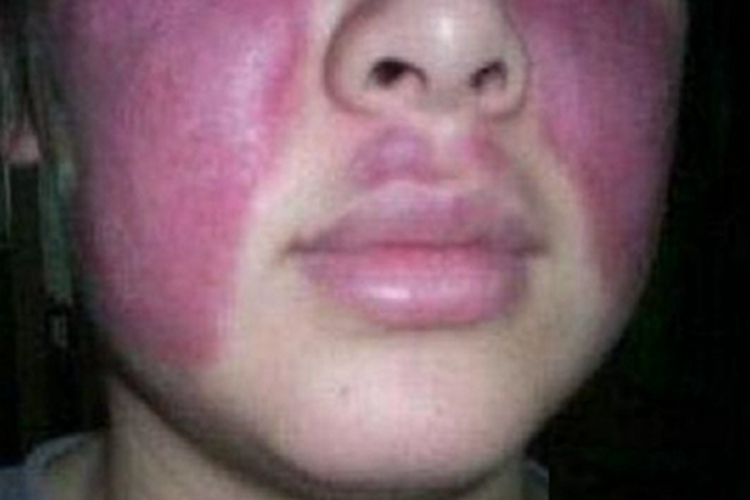 硬红斑面部斑块图 硬红斑面部斑块图