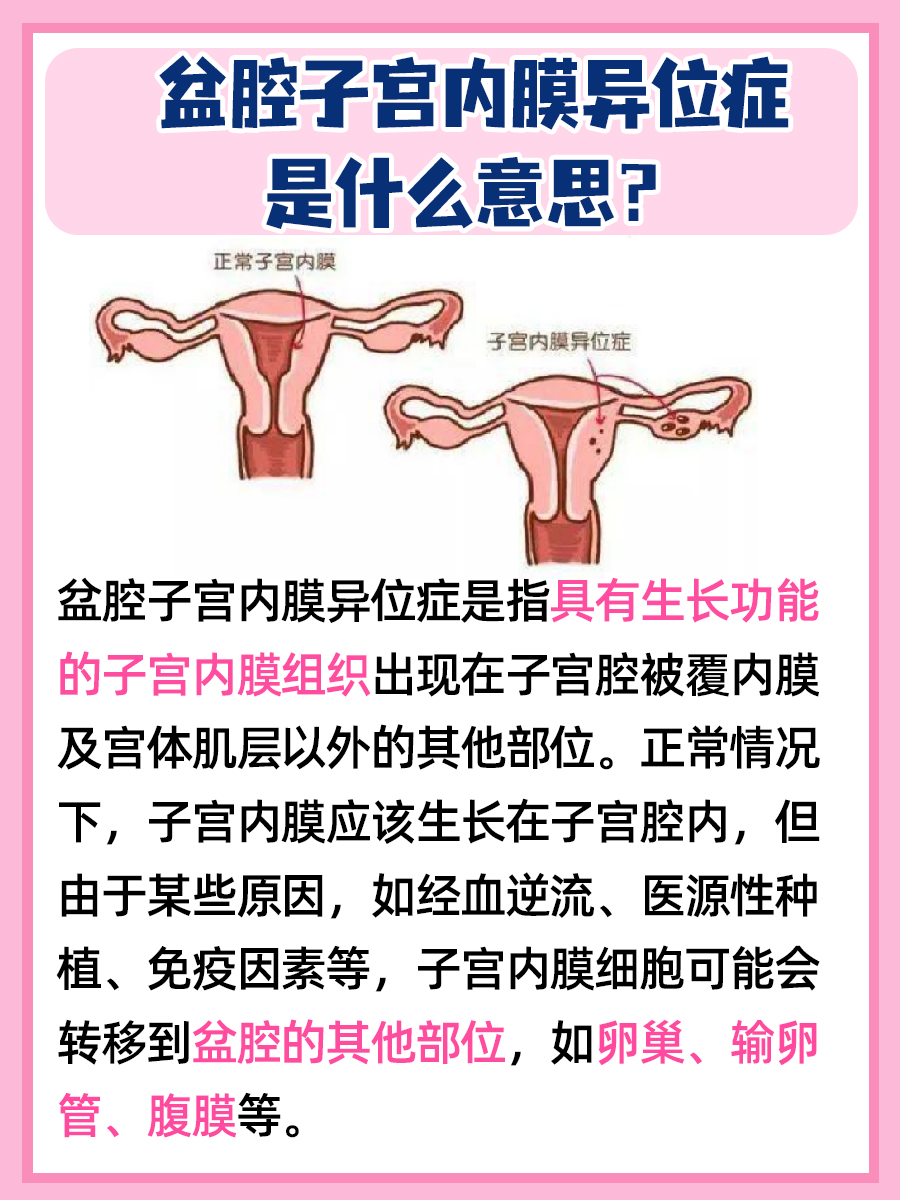揭秘:何为盆腔子宫内膜异位?