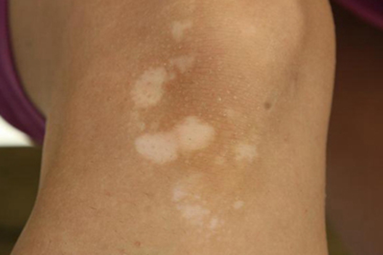 结节性硬化症膝盖白斑图 结节性硬化症膝盖白斑图