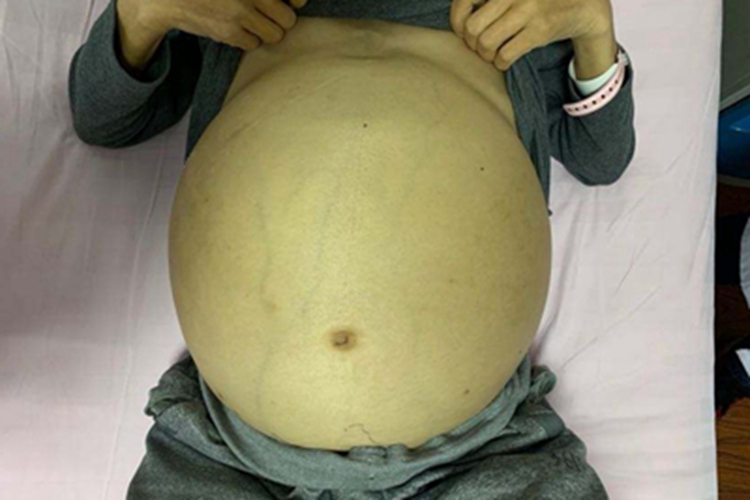 肝硬化腹腔积液图