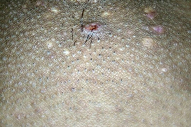 毛囊炎肛周溃疡图