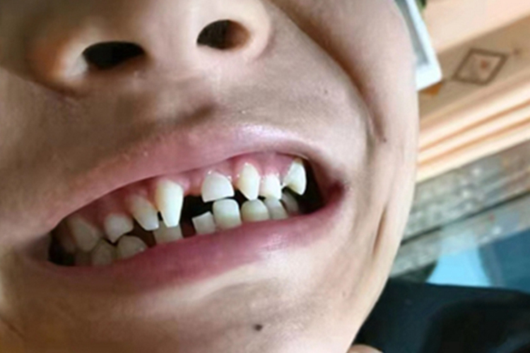 多生牙牙齿畸形缝隙大图