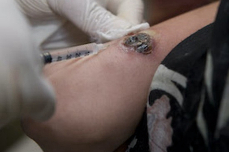 皮肤利什曼病胳膊症状图