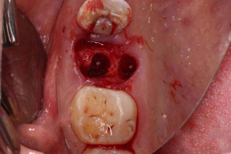 拔完牙24小时后恢复图