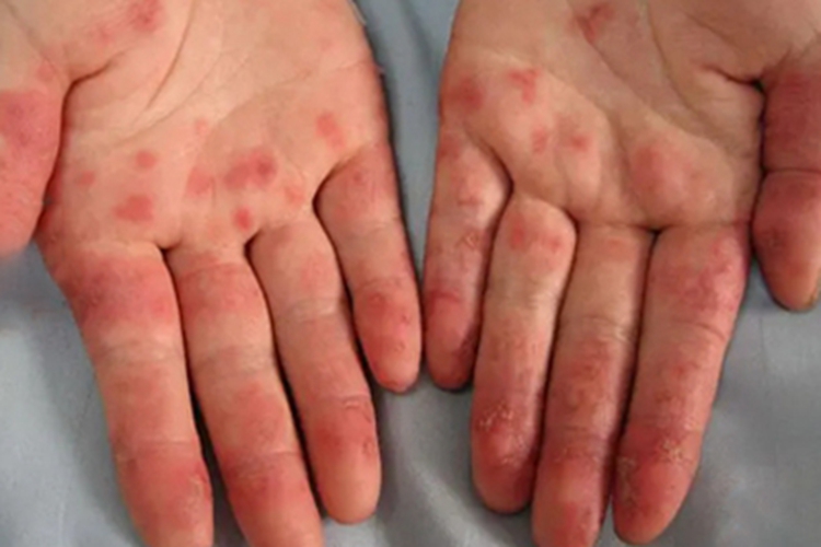 系统性红斑狼疮手掌症状图