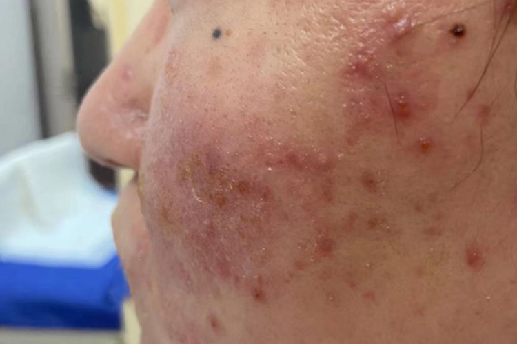 湿疹脸上长疙瘩图