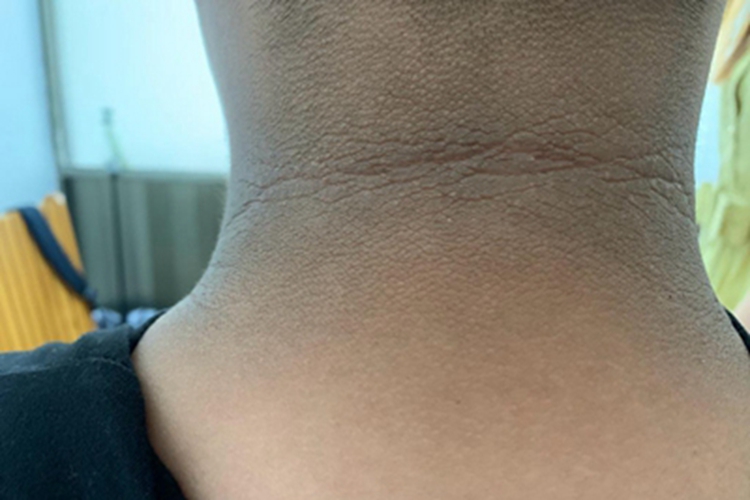 假性黑棘皮病颈部症状图