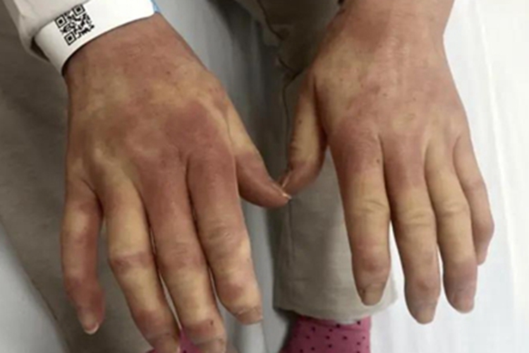 松毛虫皮炎手关节肿胀图