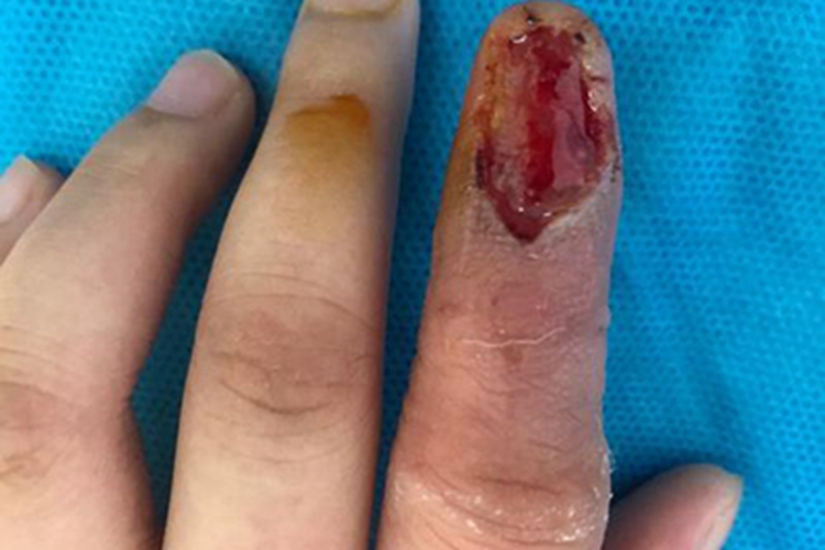 甲床炎手指甲出血图