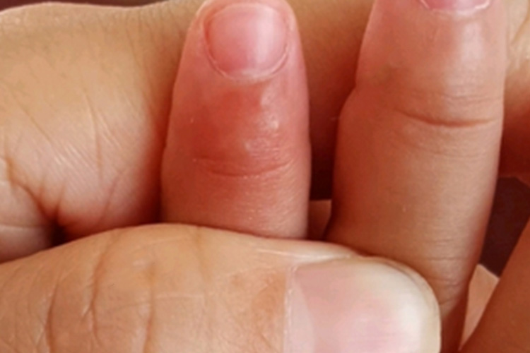 手指汗疱疹图