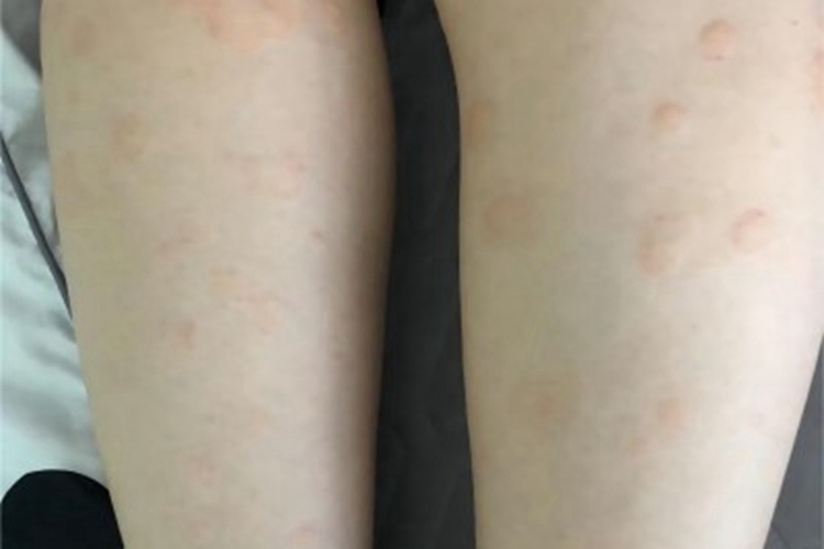 青霉素过敏小腿风团图 青霉素过敏小腿风团图