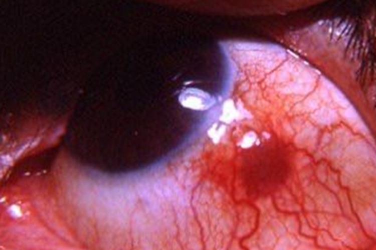 结节性表层巩膜炎眼球肿图