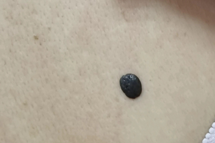 复合痣背部症状图 复合痣背部症状图