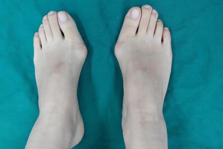 大脚趾拇外翻图