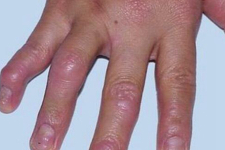 关节病型银屑病红肿图