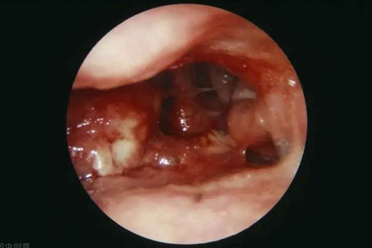 鼻咽癌肿瘤图片